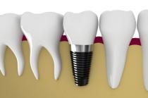 Artistic rendering of teeth and a dental implant in cross-section