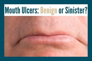 Closeup of frowning man's mouth with text "Mouth ulcers: benign or sinister?"