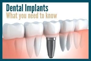 Illustration of a dental implant in cross section with the words "Dental Implants - What you need to know".