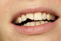 An image of a mouth showing one broken tooth
