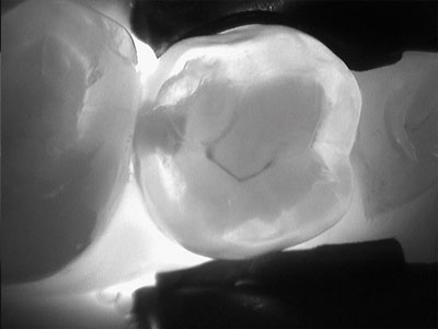 Image of a tooth taken using a Diagnocam