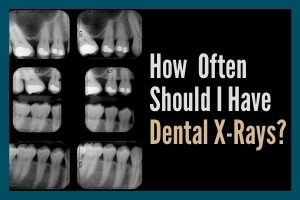 How often should I have dental x-rays?